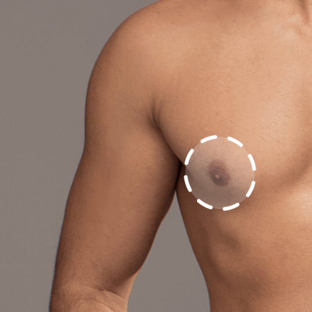 Areola